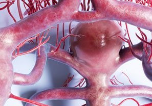 Aneurysm and Dissection