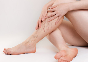 Varicose Veins
